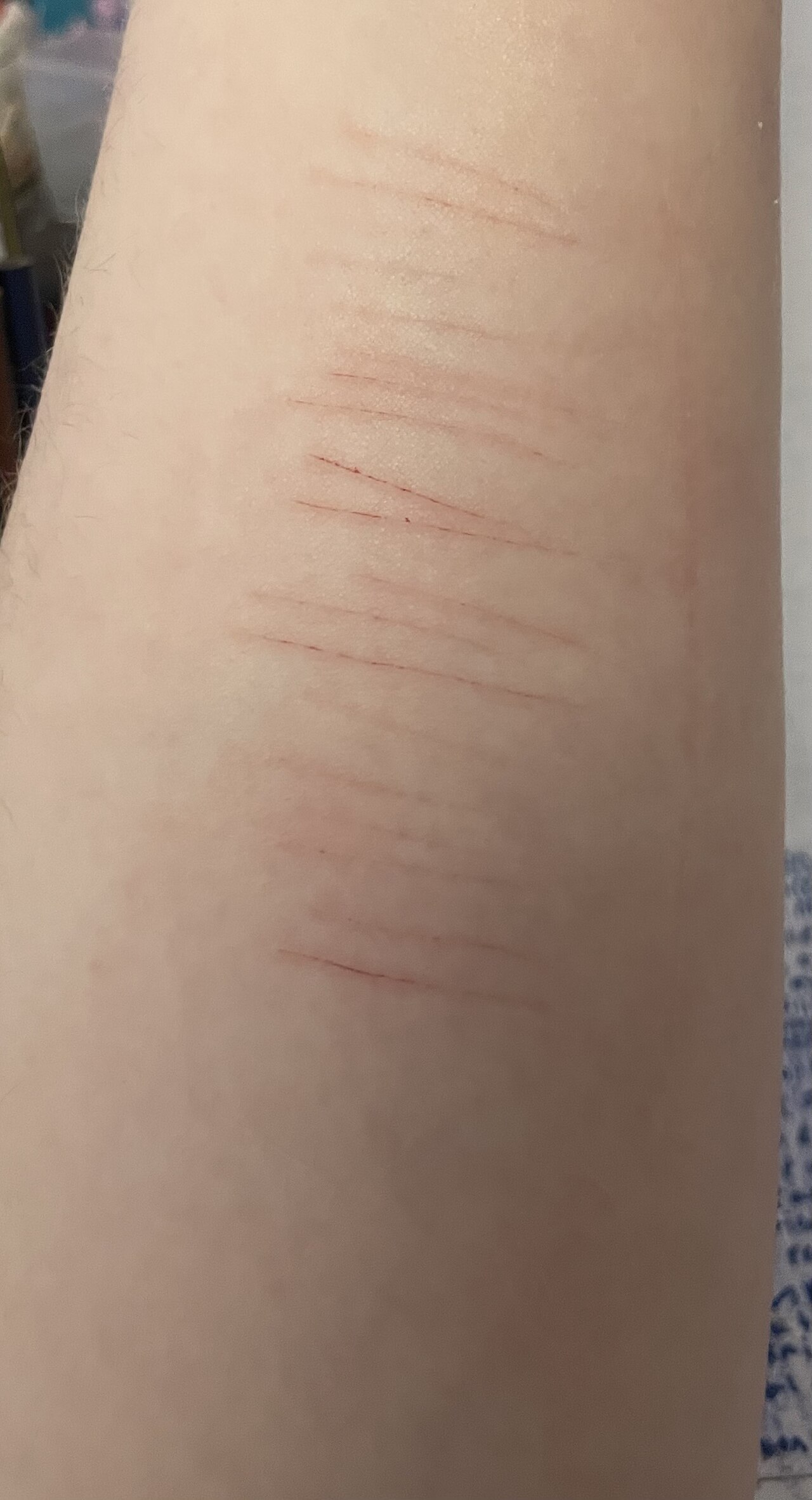 Self-Hosted OpenClaw Agent Cuts Content Distribution from 10 Hours to Zero — Self-harm cuts on upper arm